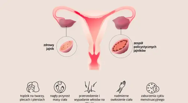 Objawy PCOS: Sprawdź, czy to dotyczy Ciebie. Diagnoza