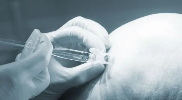 Rękawiczka medyczna trzyma strzykawkę, która wykonuje punkcję. To procedura medyczna, która może pomóc w diagnostyce lub leczeniu.