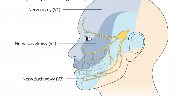 Schematyczny rysunek głowy z zaznaczonymi obszarami unerwienia nerwu trójdzielnego: nerw oczny (V1), szczękowy (V2) i żuchwowy (V3).
