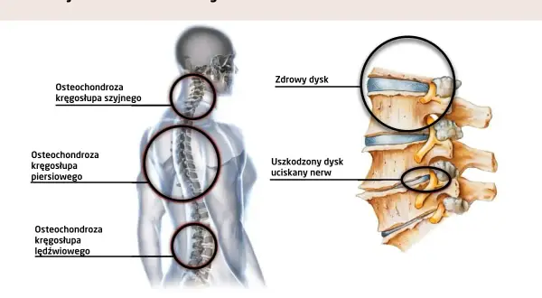 Kiedy neurolog leczy kręgosłup? Objawy, diagnoza, leczenie