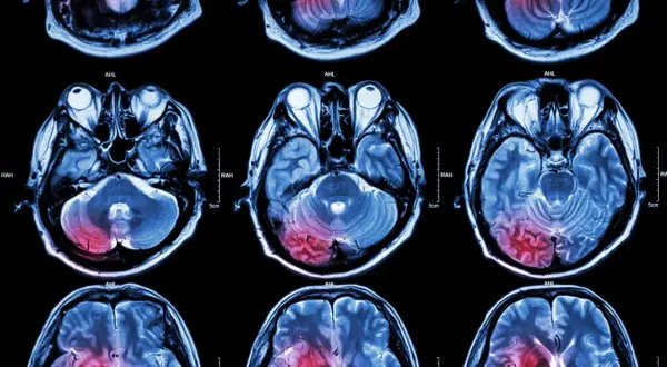 Udar: Stymulacja mózgu. Jak odzyskać sprawność i neuroplastyczność?