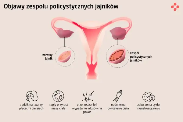 Objawy PCOS: Sprawdź, czy to dotyczy Ciebie. Diagnoza