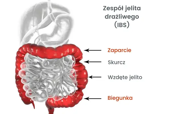 Syndrom Habba: Objawy, które mylisz z IBS. Jak rozpoznać i leczyć?